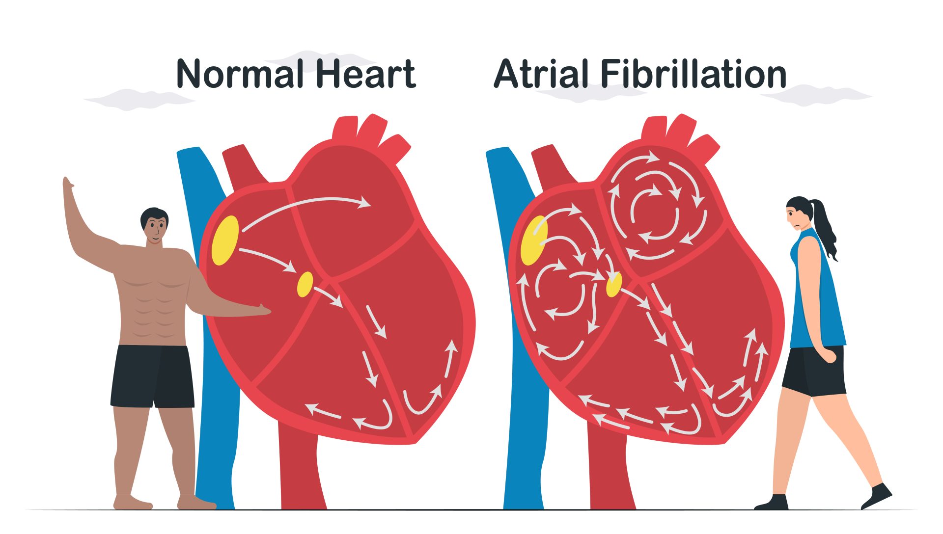 Normal Heart andAtrial Fibrillation